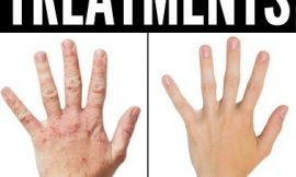 Best 5 Homeopathic Treatments For Eczema That Work