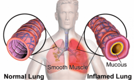 Asthma and Bronchitis – What you Should Know