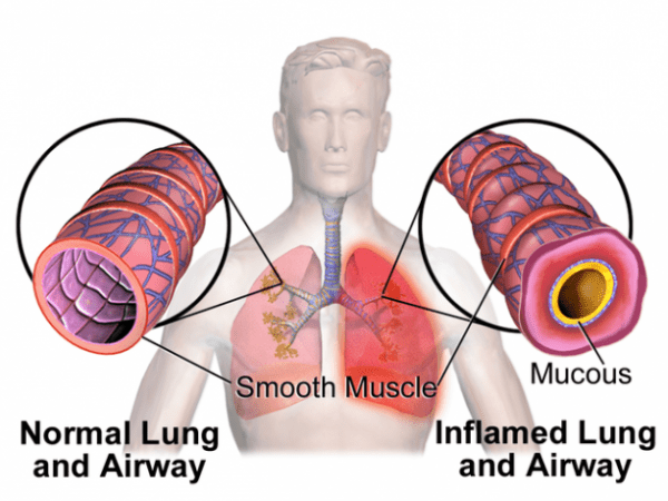 Asthma and Bronchitis - What You Should Know
