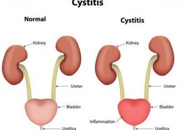 Cystitis: Symptoms, Causes, and Treatments