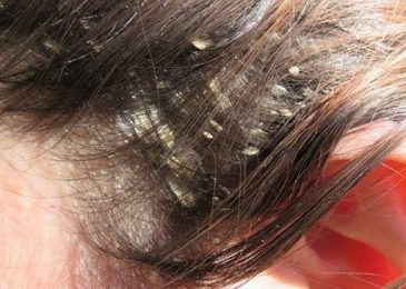 How To Cures Dandruff Naturally