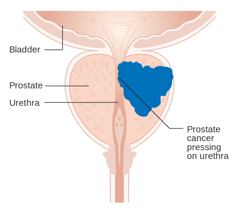Prostate Cancer - Symptoms and Causes