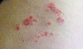 Shingles – Most Symptoms and Causes