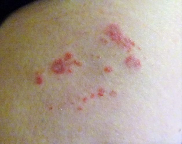 Shingles - Symptoms and Causes