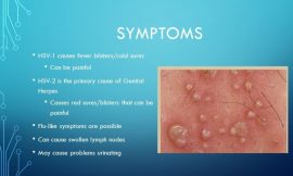 Most 7 Various Facts About Genital Herpes