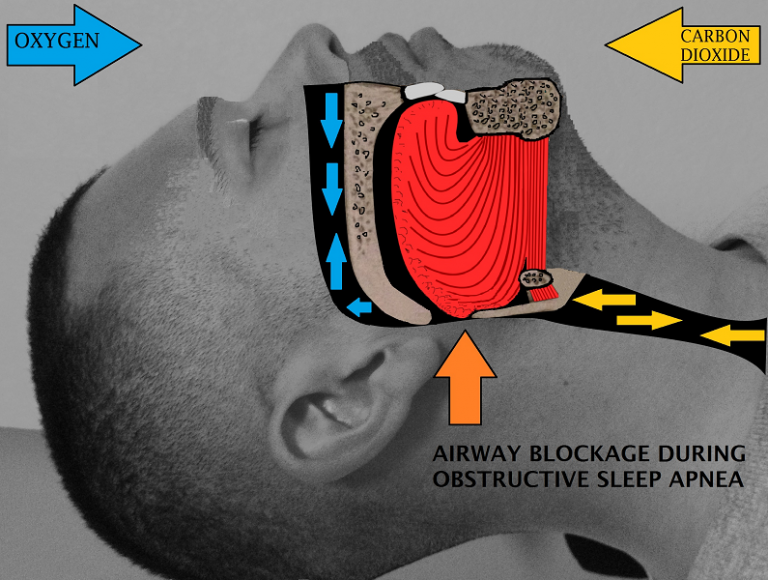 What's the Difference Between Snoring and Sleep Apnea?