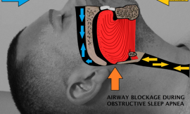 What’s the Difference Between Snoring and Sleep Apnea?