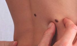 How To Get Rid Skin Tag?