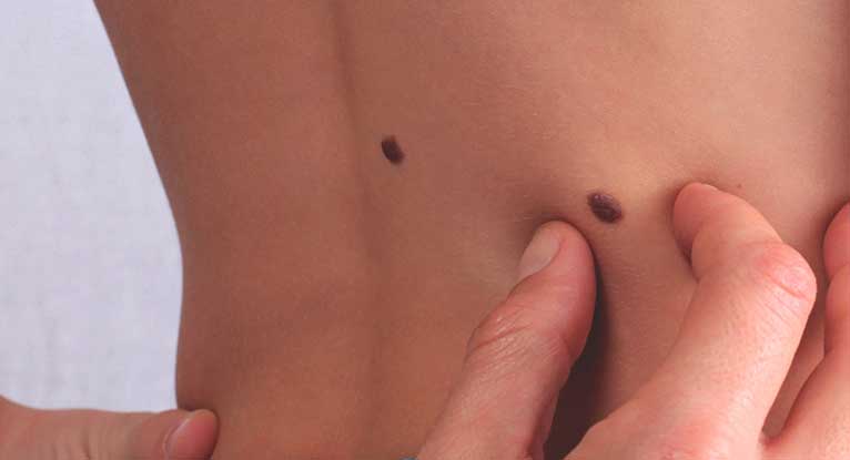 Skin Tag - All What you Should Know