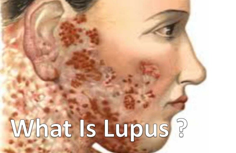What is Lupus?