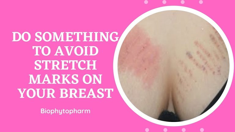 Do Something to Avoid Stretch Marks on Your Breast
