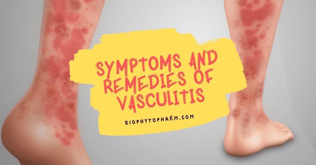 Symptoms and Remedies of Vasculitis